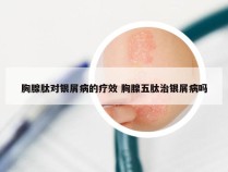 胸腺肽对银屑病的疗效 胸腺五肽治银屑病吗