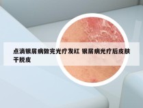 点滴银屑病做完光疗发红 银屑病光疗后皮肤干脱皮