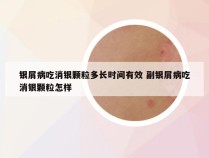 银屑病吃消银颗粒多长时间有效 副银屑病吃消银颗粒怎样