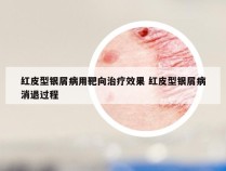 红皮型银屑病用靶向治疗效果 红皮型银屑病消退过程