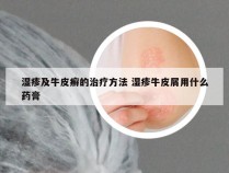 湿疹及牛皮癣的治疗方法 湿疹牛皮屑用什么药膏