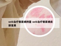 uvb治疗银屑病剂量 uvb治疗银屑病皮肤变黑