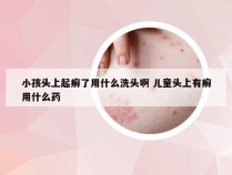 小孩头上起癣了用什么洗头啊 儿童头上有癣用什么药