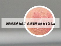 点滴银屑病自愈了 点滴银屑病自愈了怎么办