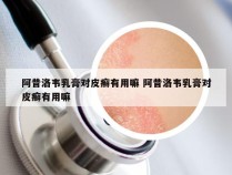 阿昔洛韦乳膏对皮癣有用嘛 阿昔洛韦乳膏对皮癣有用嘛