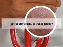 蒲公英可以治癣吗 蒲公英能治癣吗?