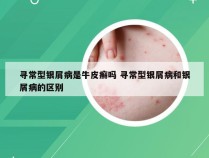 寻常型银屑病是牛皮癣吗 寻常型银屑病和银屑病的区别