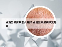 点滴型银屑病怎么算好 点滴型银屑病恢复趋势