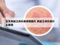 女生两腿之间长癣初期图片 两腿之间长癣什么原因