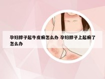 孕妇脖子起牛皮癣怎么办 孕妇脖子上起癣了怎么办