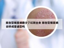 脓包型银屑病胞少了红斑全身 脓包型银屑病会转成普通型吗