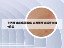 先天性银屑病艾滋病 先患银屑病后查出hiv感染