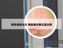 银屑病用冰片 银屑病冷敷还是热敷