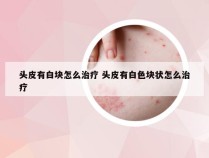 头皮有白块怎么治疗 头皮有白色块状怎么治疗