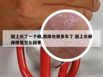 腿上长了一个癣,很痒也很多年了 腿上长癣痒痒是怎么回事