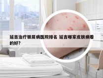 延吉治疗银屑病医院排名 延吉哪家皮肤病看的好?