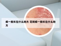 癣一般长在什么地方 花斑癣一般长在什么地方