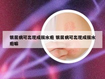 银屑病可出现成簇水疱 银屑病可出现成簇水疱嘛