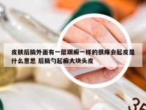 皮肤后脑外面有一层跟癣一样的很痒会起皮是什么意思 后脑勺起癣大块头皮