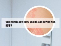 银屑病的红斑光滑吗 银屑病红斑变大是怎么回事?