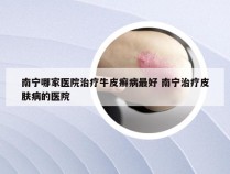 南宁哪家医院治疗牛皮癣病最好 南宁治疗皮肤病的医院