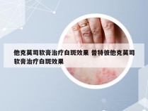 他克莫司软膏治疗白斑效果 普特彼他克莫司软膏治疗白斑效果