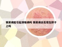 银屑病能引起颈椎病吗 银屑病会出现在脖子上吗