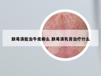 肤毒清能治牛皮癣么 肤毒清乳膏治疗什么