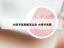 小孩子出现癣怎么办 小孩子长藓