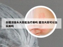 白醋泡独头大蒜能治疗癣吗 醋泡大蒜可以治头癣吗