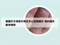 癣图片不疼就不痒在手心的癣图片 癣的图片都有哪些