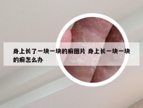 身上长了一块一块的癣图片 身上长一块一块的癣怎么办