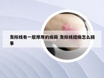 发际线有一层厚厚的痂藓 发际线结痂怎么回事