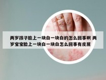 两岁孩子脸上一块白一块白的怎么回事啊 两岁宝宝脸上一块白一块白怎么回事有皮屑