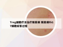 Treg细胞疗法治疗银屑病 银屑病th17细胞应答过程