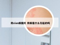 阴xian癣图片 阴癣是什么引起的吗