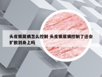 头皮银屑病怎么控制 头皮银屑病控制了还会扩散到身上吗