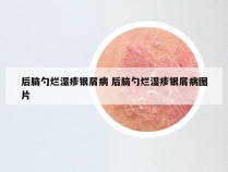 后脑勺烂湿疹银屑病 后脑勺烂湿疹银屑病图片