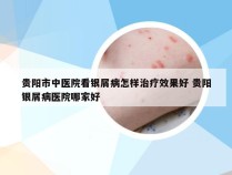 贵阳市中医院看银屑病怎样治疗效果好 贵阳银屑病医院哪家好