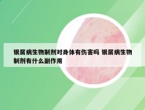 银屑病生物制剂对身体有伤害吗 银屑病生物制剂有什么副作用