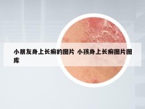 小朋友身上长癣的图片 小孩身上长癣图片图库