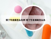 得了牛皮癣怎么办啊 得了牛皮病癣怎么办