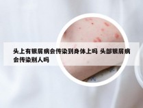 头上有银屑病会传染到身体上吗 头部银屑病会传染别人吗