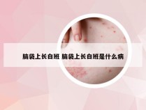 脑袋上长白班 脑袋上长白班是什么病