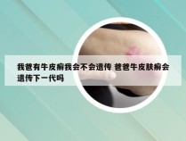 我爸有牛皮癣我会不会遗传 爸爸牛皮肤癣会遗传下一代吗