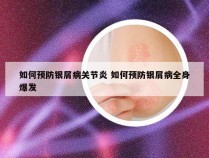 如何预防银屑病关节炎 如何预防银屑病全身爆发