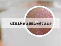 儿童脸上长癣 儿童脸上长癣了怎么办