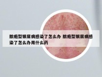 脓疱型银屑病感染了怎么办 脓疱型银屑病感染了怎么办用什么药