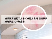 点滴银屑病起了几个红点是复发吗 点滴银屑病每天起几个红疙瘩