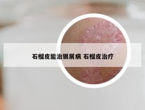 石榴皮能治银屑病 石榴皮治疗